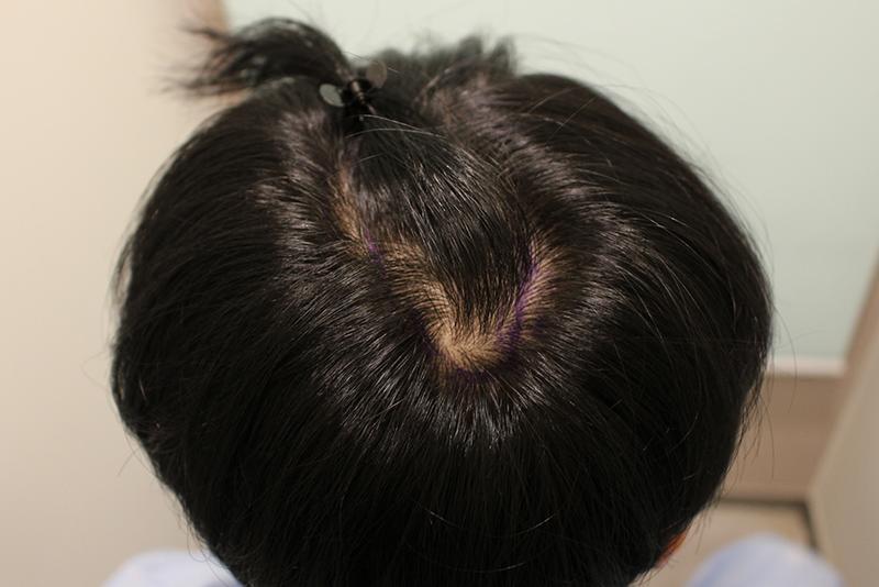 ヘアライン+窯の密度強化5ヶ月のレビューです！