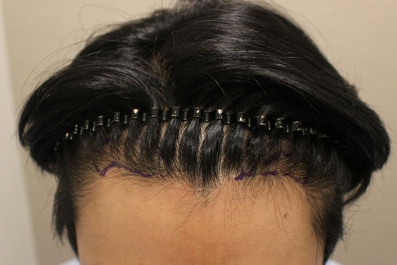 ヘアライン+かまど、望むところだけ集中的に6ヶ月