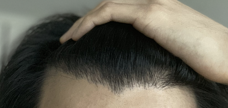 It's the 7th month of the second hair transplant