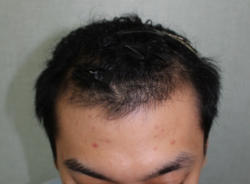 The incision type 4,794 hair is 3 months late.