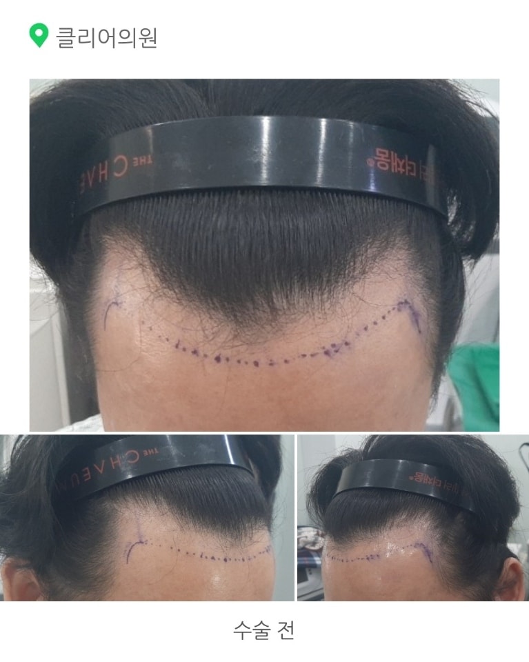 3천모 비절개로 이식하였습니다.
