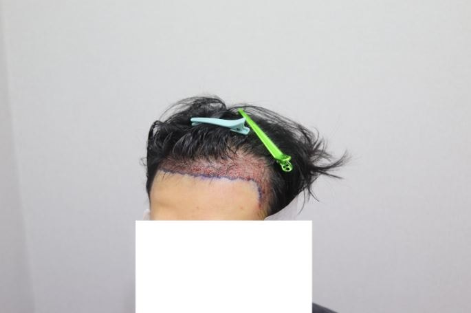 수술 직후_좌.JPG