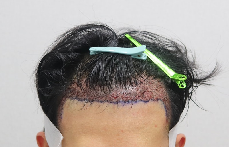 수술 직후_정면_확대.jpg