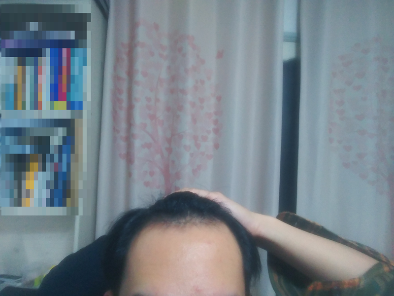 약 복용 전_정면.png