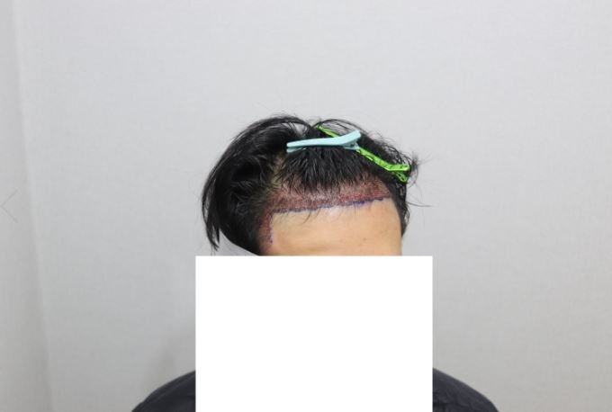 수술 직후_우.JPG