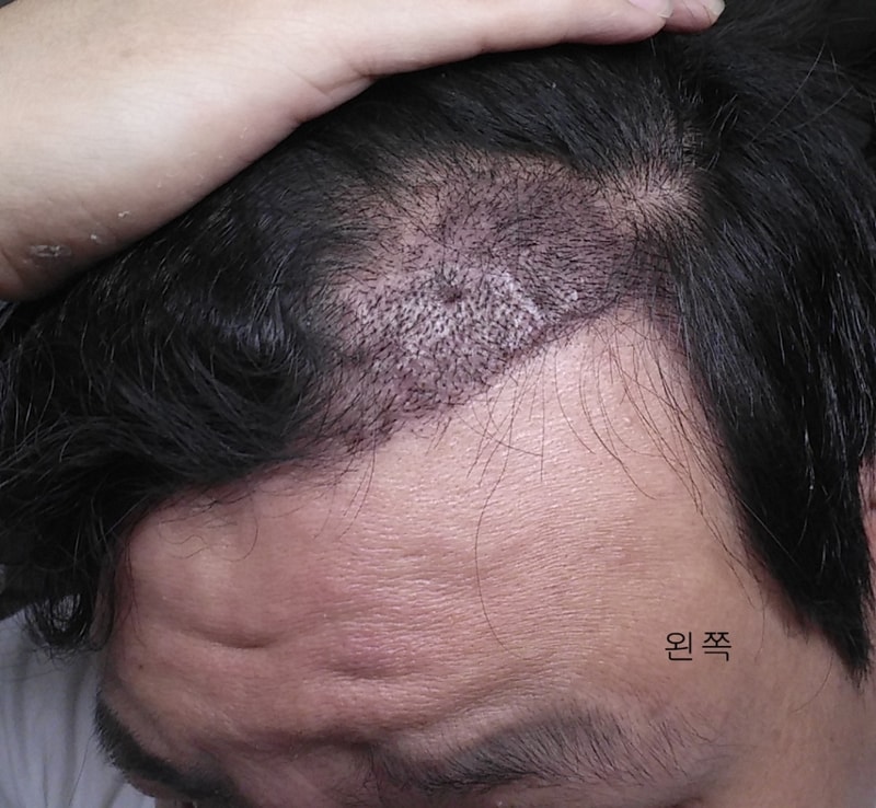 Post a picture of the 2nd week's piggyback removal and density.