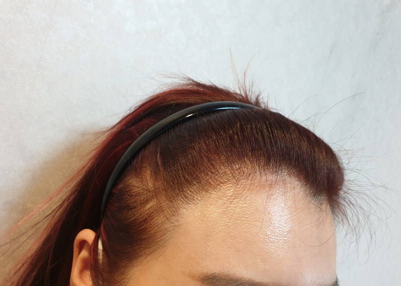 Hairline Hair Transplantation (No-Cutting-Out 800 Hair Bag) 9 Months