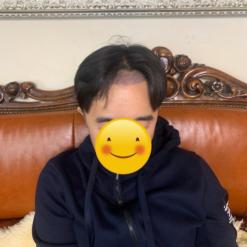 Nobline非切开毛发移植2960毛囊。 第14天。