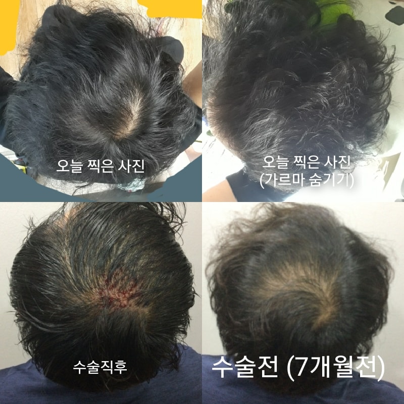 미켈란 후기(7개월 후기)