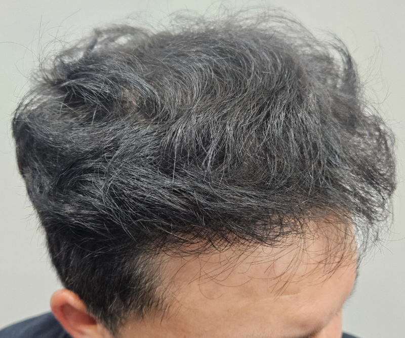 모재성 비절개 5109모 1년후기입니다