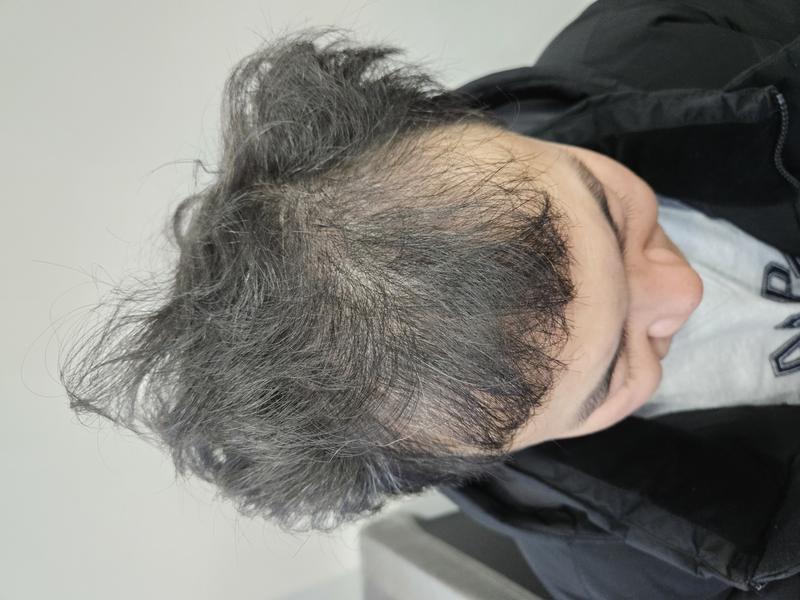 [モ·ジェソン] 手術3ヵ月目のレビューです