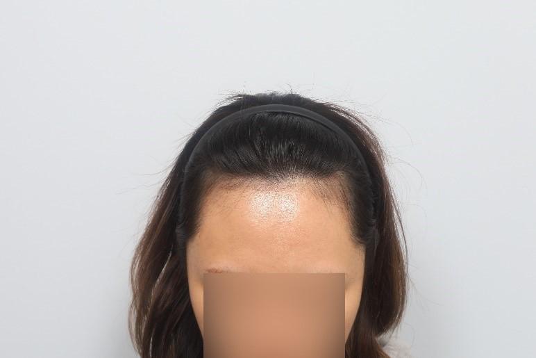 Women's hairline partial cut non-cut hair transplant 7 months Mo Won plastic surgery surgery