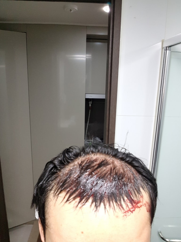 [회전]20190312_수술후.jpg