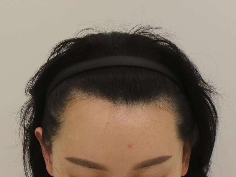 釜山 マンモス ヘアライン矯正 7ヶ月経過