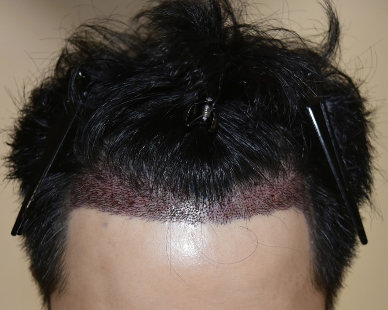 수술1일차1.jpg