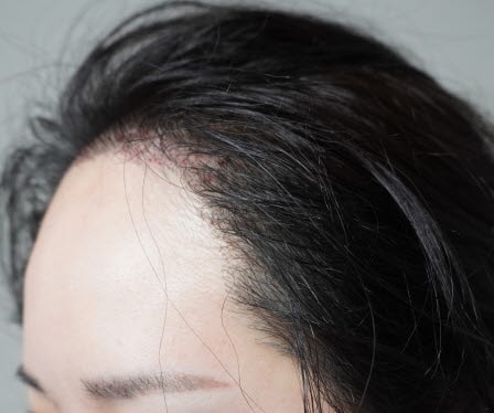 포모아의원에서 헤어라인 교정 이제 나도 카리나? ㅎ