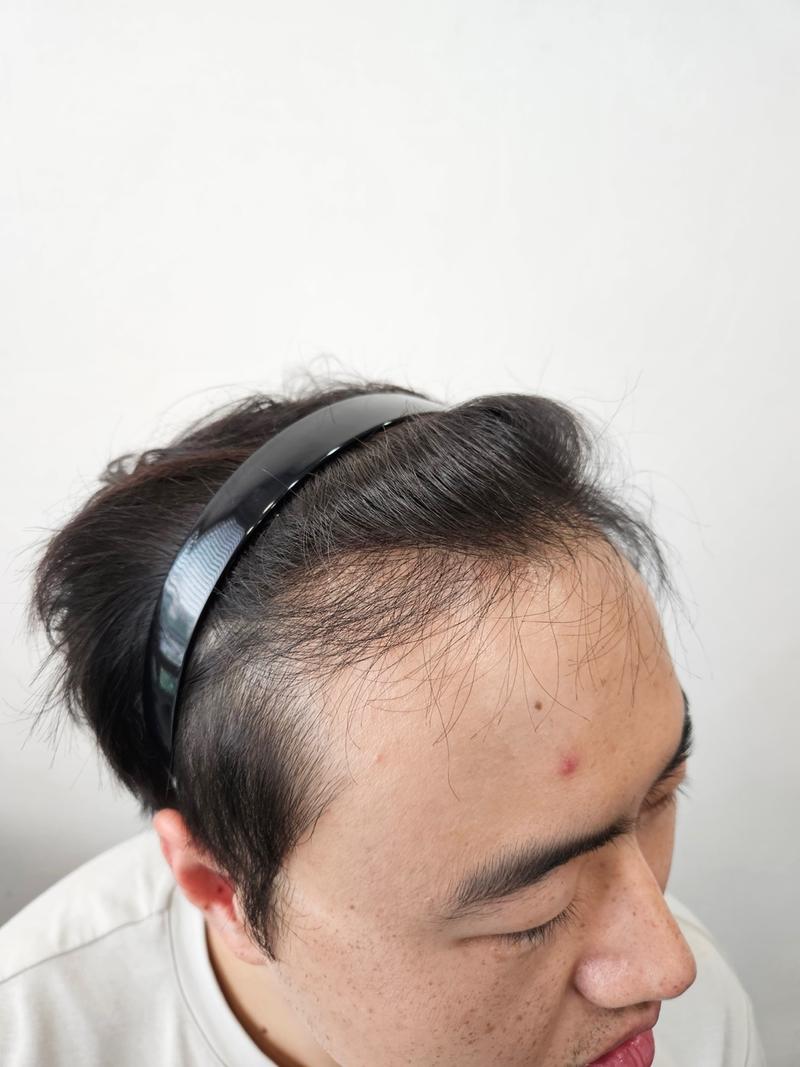 5 Months of Non-Cutting Hair Transplantation