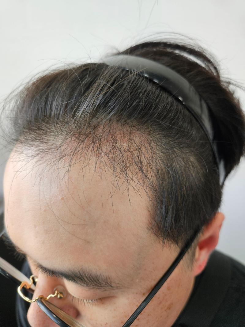A month and a half review of hair transplantation