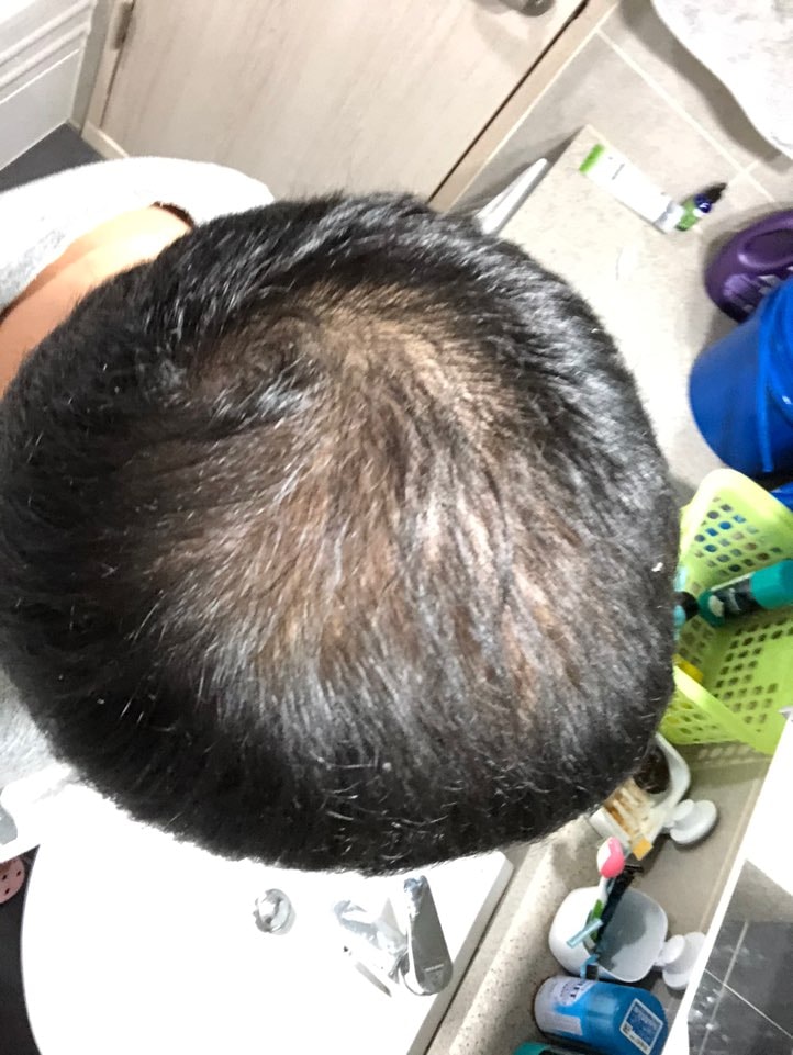 정수리한지 90일입니다