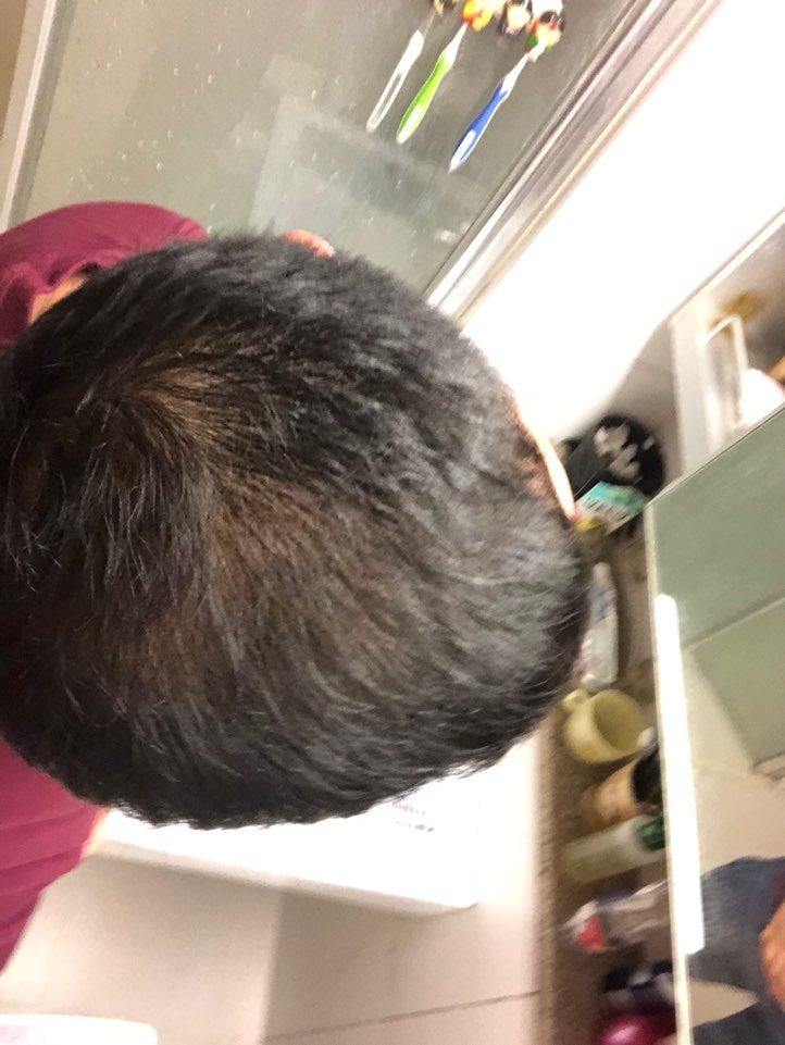 정수리 120일 사진입니다