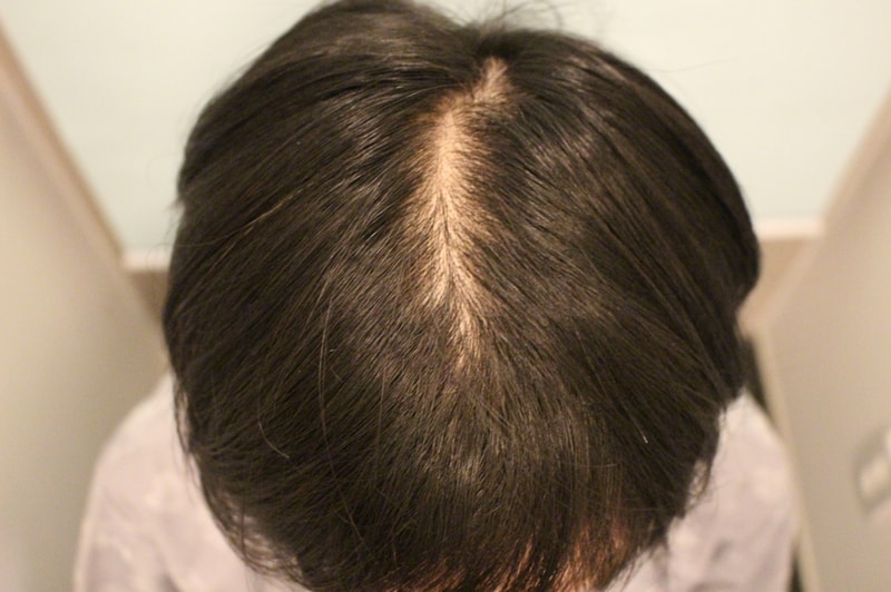 *真医生女性头顶发缝1年变化