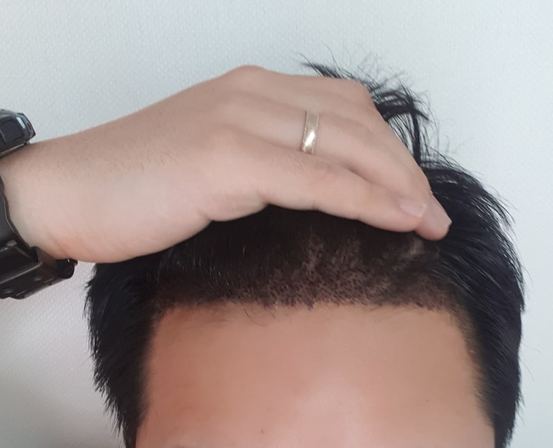 無削髪非切開から4日です