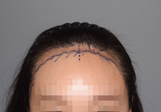 너무 오랜만에 왔어요 헤어라인한지 17개월~ 이네요