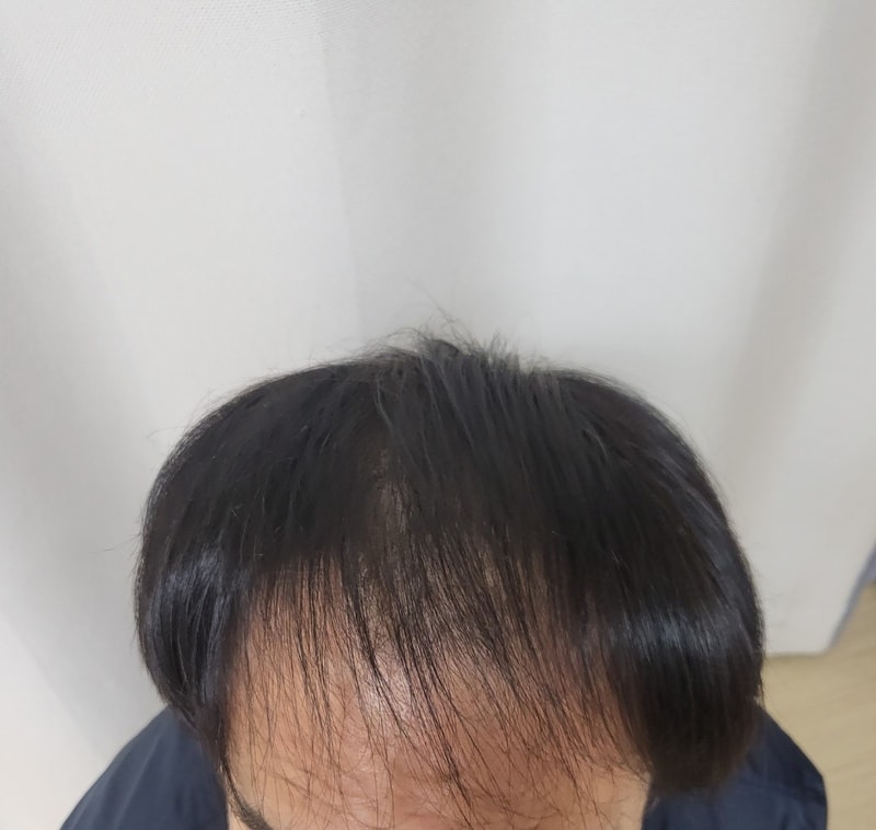 Dana Plastic Surgery 3300 hair follicle transplant 10 months later