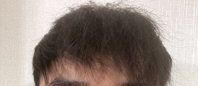 It's been a month since Dana shaved her head