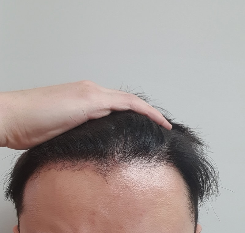 3차 수술 42일차