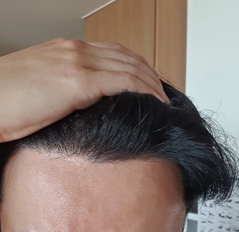 재수술 9개월인데 고민 하나 생겼어요
