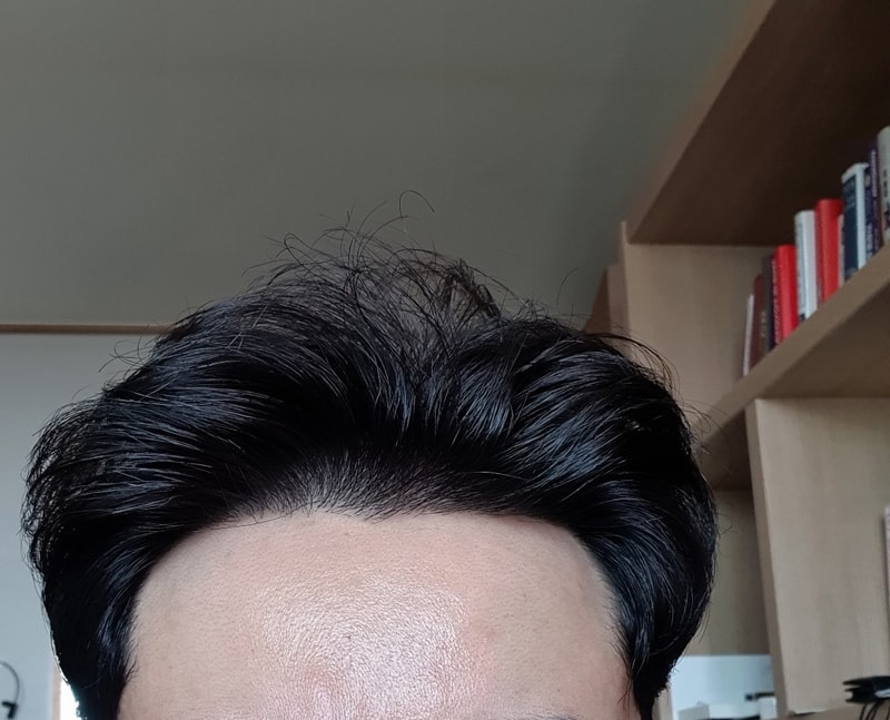 재수술 10개월이고 마지막으로 한 번 더 하려고 생각 중입니다