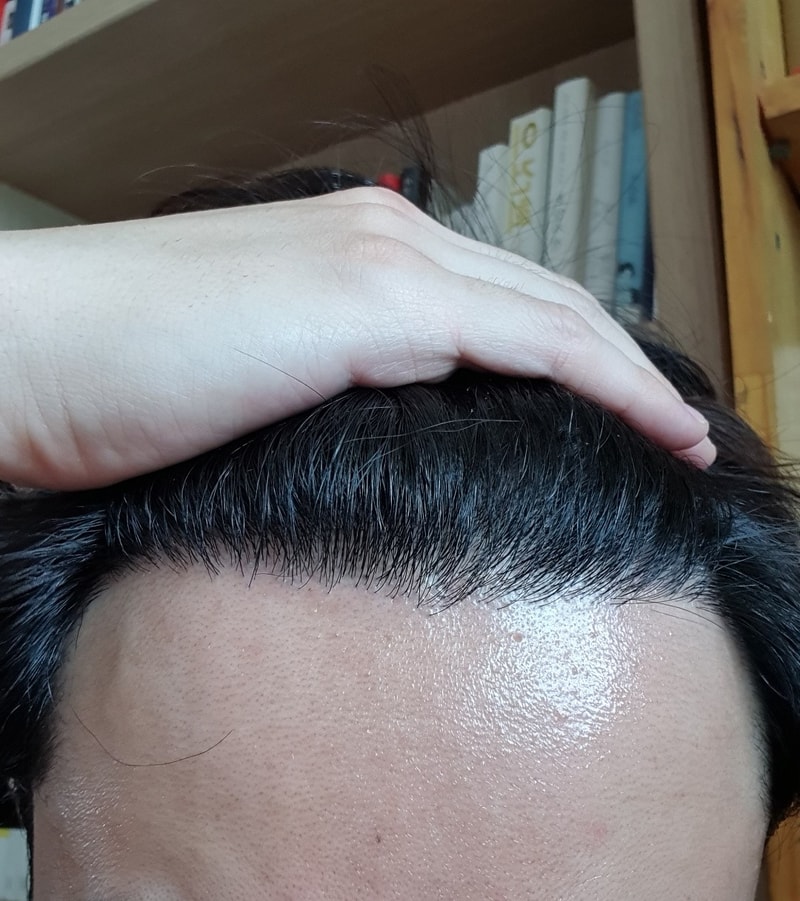 재수술 8개월 박수가 쳐지는 결과^^