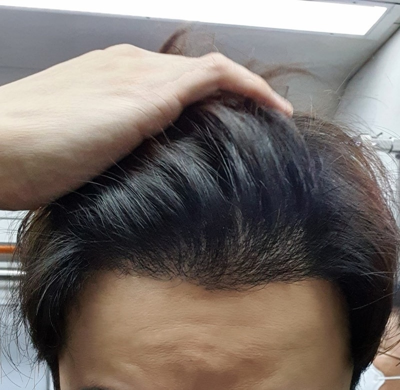 재수술 5개월입니다