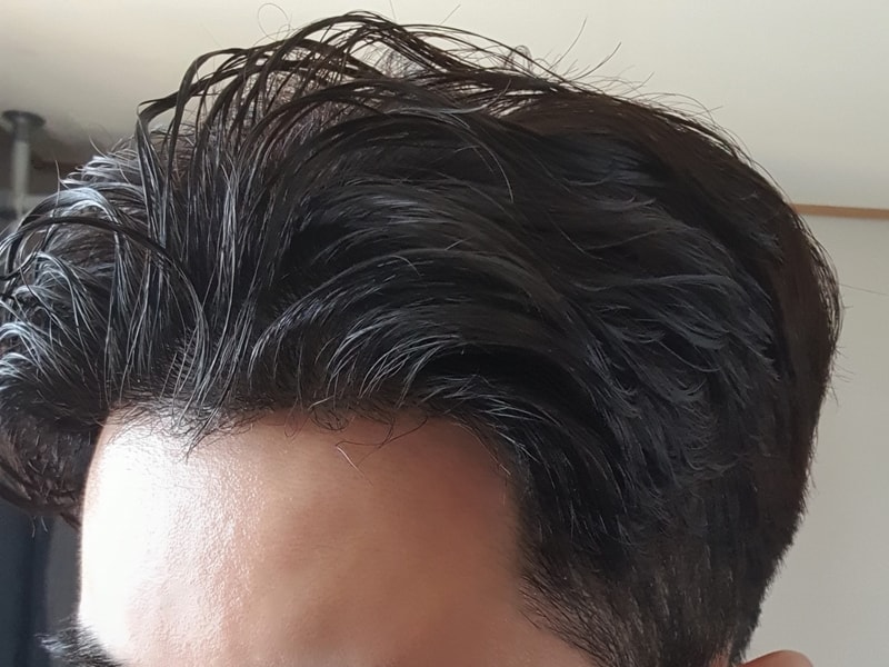 3차 수술한지 1년 다 돼가네요