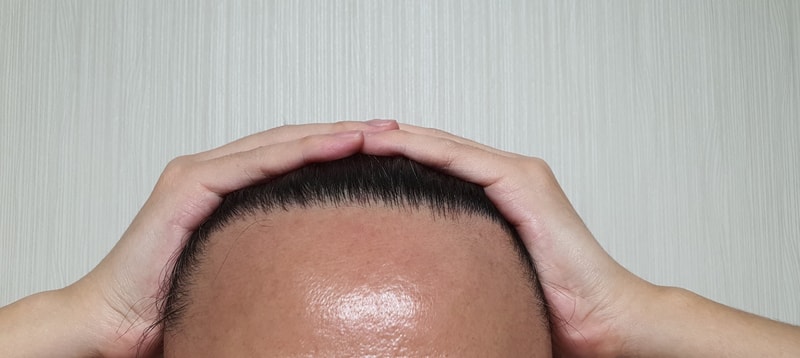 無削髪費切り7ヵ月の近況です
