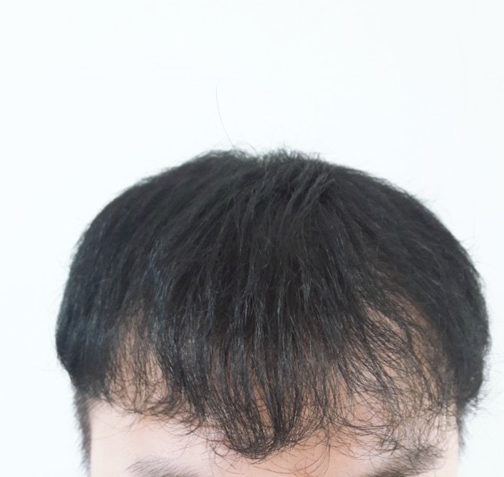 재수술 5개월. 효과가 있긴 있네요