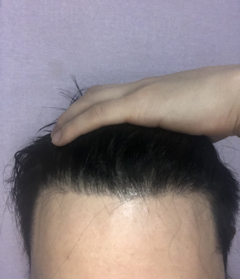 재수술5개월요