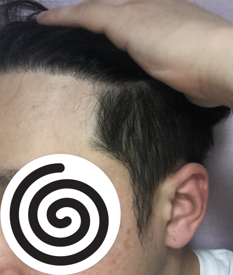 재수술8개월