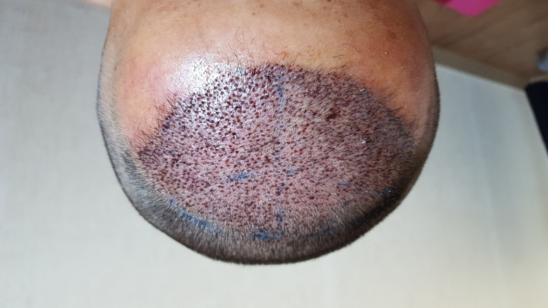Day 1 of non-cut 1800 hair follicles