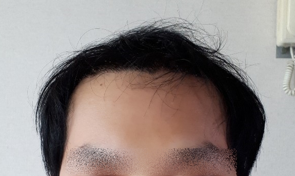 수술 후 10일 (정면).jpg