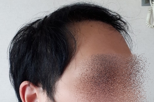 수술 후 10일 (오).jpg