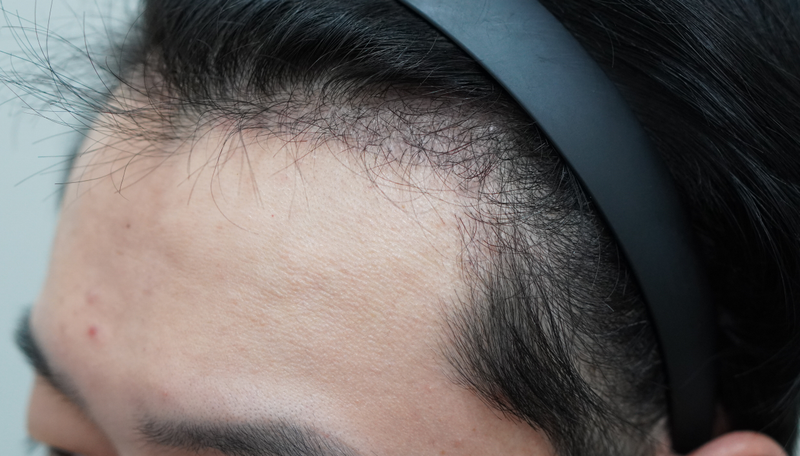 Glow Clinic (formerly New Hair Busan) M-shaped hair transplant, 2000 m-shaped, and 3 months of hair transplantation