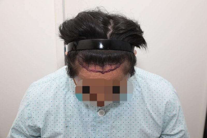 ニューヘアソウル店 非切開 毛髪移植1600毛包7ヶ月目のレビューです~