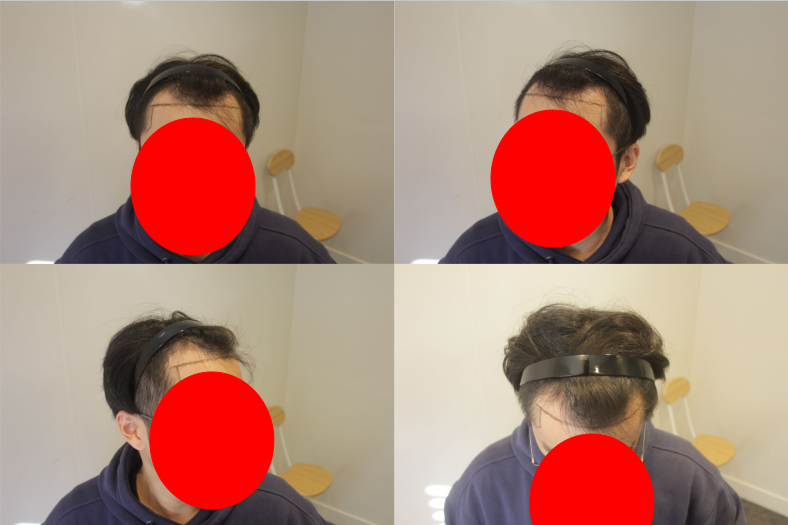 New Hair 首尔店非切开毛发移植 1800 毛囊(3600 毛) 6个月后期