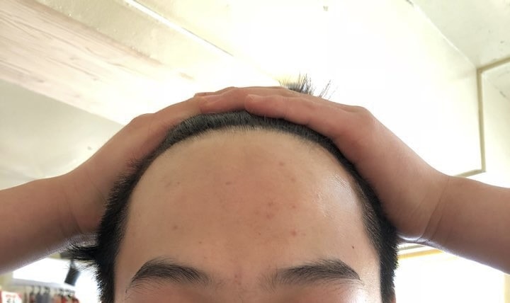 宽阔的额头填满！！ 终于，毛发移植切开1500毛囊
