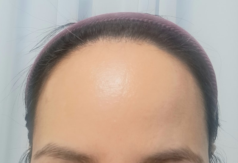 发际线移植了。
