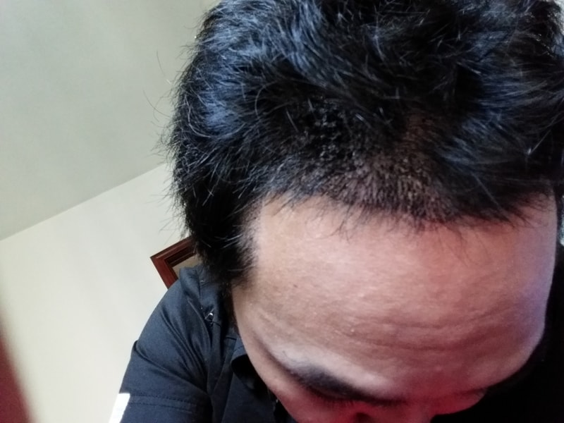 오늘 중국 모발이식병원 다녀왔네요
