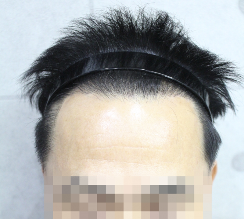 모발이숙후_3.png