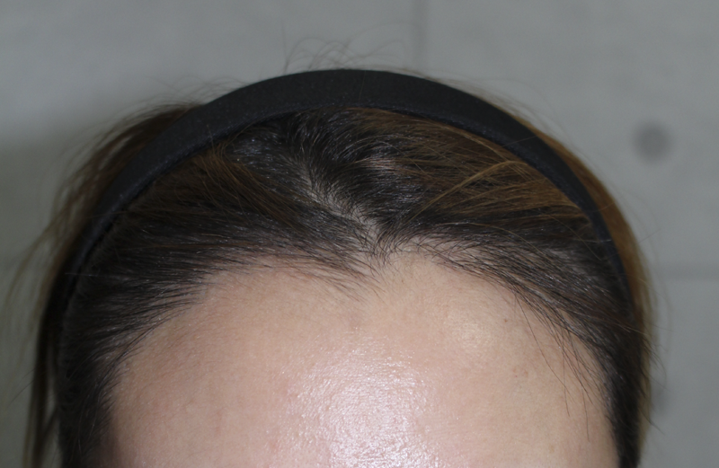ヘアラインの移植が5ヶ月になりました *^^*